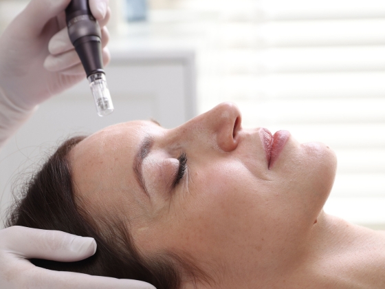 A woman with closed eyes lies on her back while a gloved hand holds a microneedling device close to her forehead, preparing for a cosmetic facial treatment in a clinical setting.